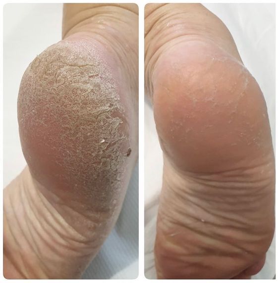 Korazi™ Precision Electric Pedicure Pro — Rechargeable Callus Remover & Foot Care Device